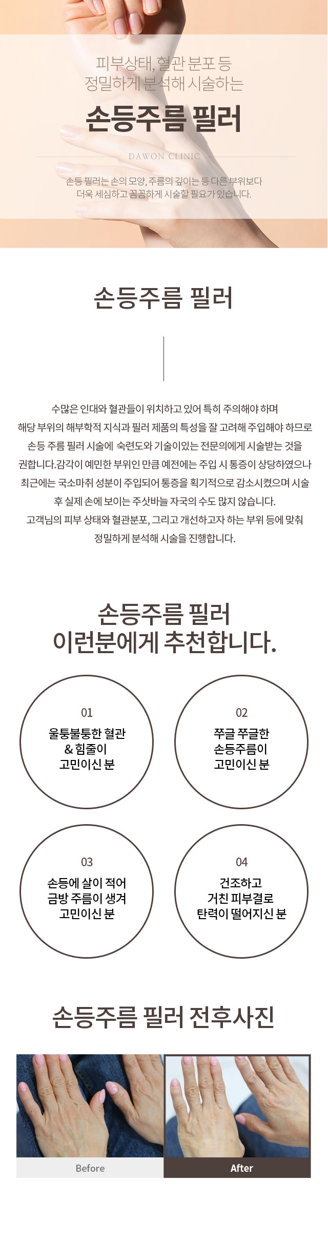 손등주름 필러